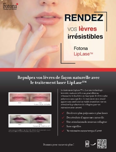 💋 LipLase® – Lèvres pulpeuses au naturel